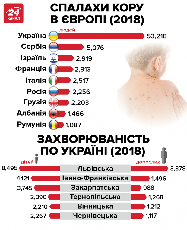 Україна очолила світовий антирейтинг за кількістю хворих на кір